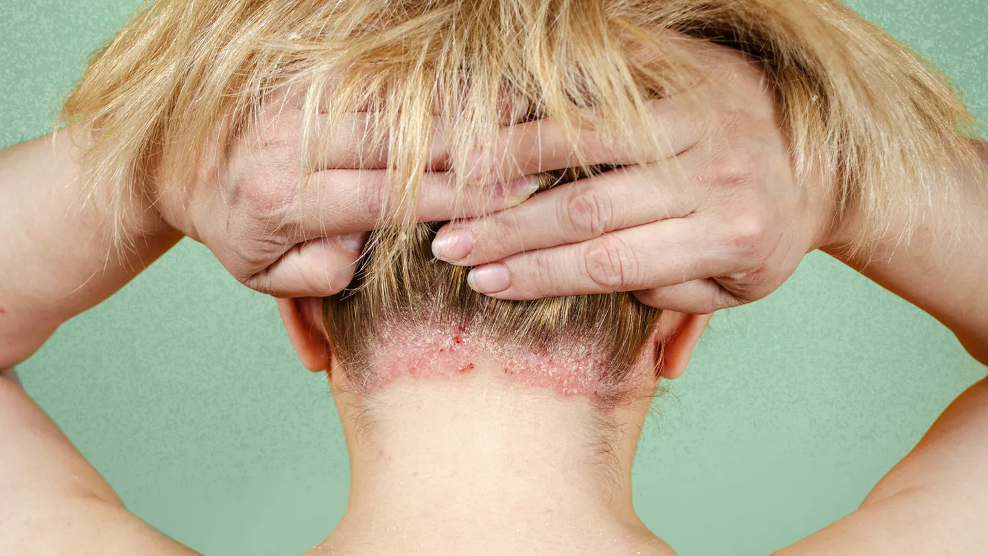 A dermatologist outlines four methods for differentiating between psoriasis of the scalp and dandruff: From discomfort to inflammation