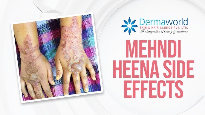 A dermatologist advises against using tainted mehendi since it may result in pigmentation, blistering, and allergic reaction. We confirm
