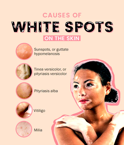 Why the sun may be the cause of those white spots on your skin
