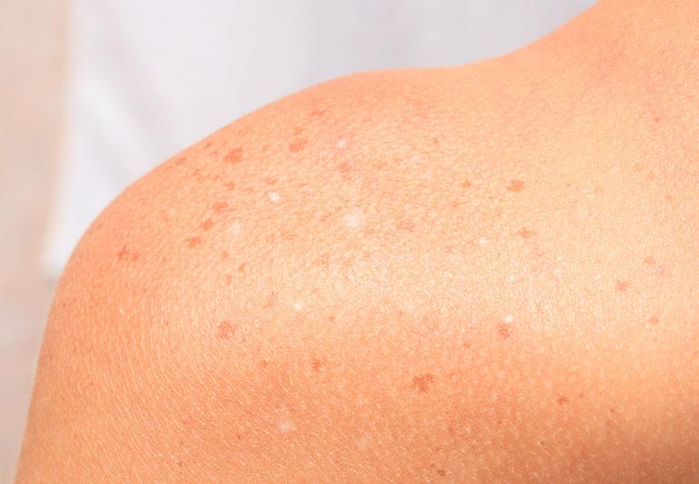 The reason those white patches on your skin may actually be connected to the sun