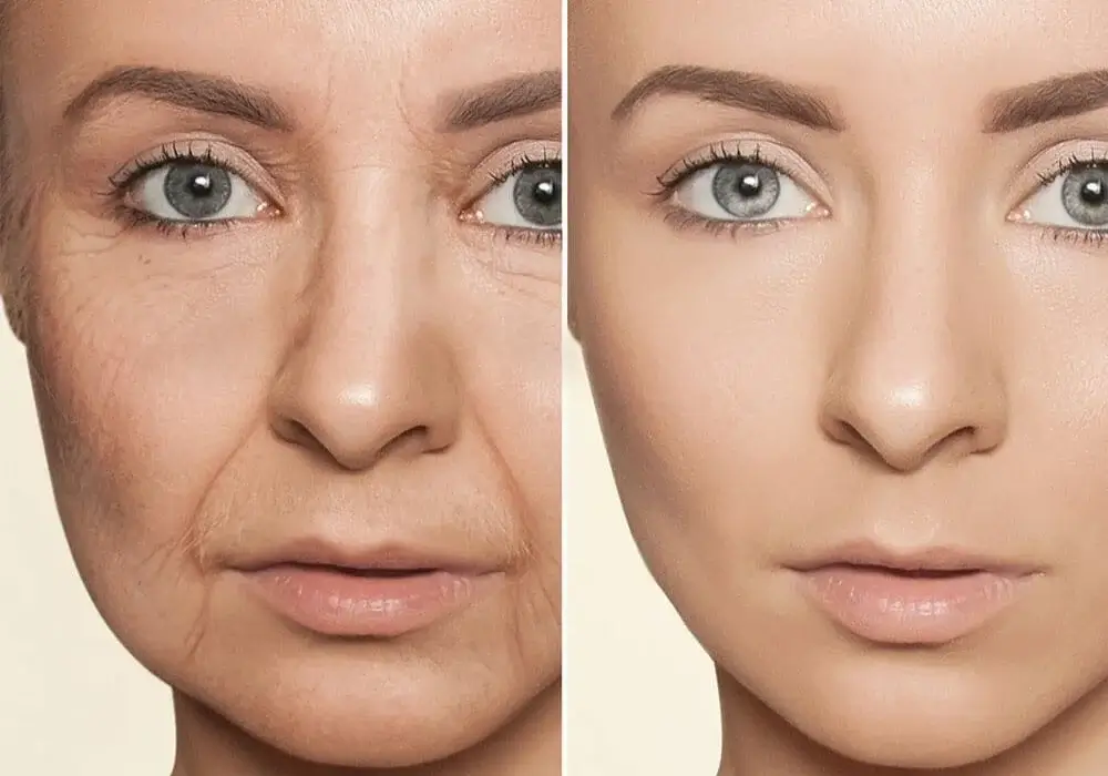 Can face acupuncture provide a more natural lift than botox and fillers?